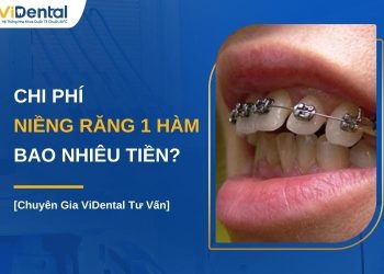 Niềng răng 1 hàm bao nhiêu tiền