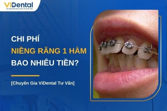 Niềng răng 1 hàm bao nhiêu tiền