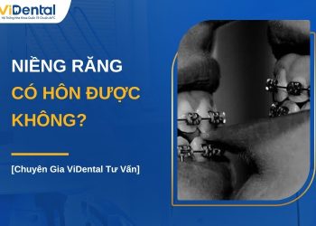 Niềng răng có hôn được không