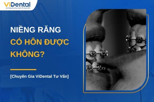 Niềng răng có hôn được không