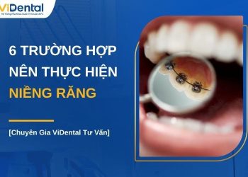 Răng như thế nào thì nên niềng