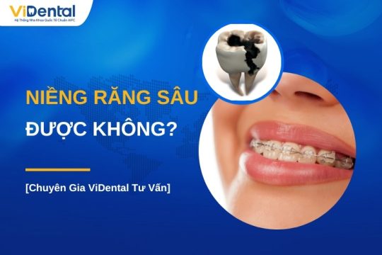 Răng sâu có niềng được không