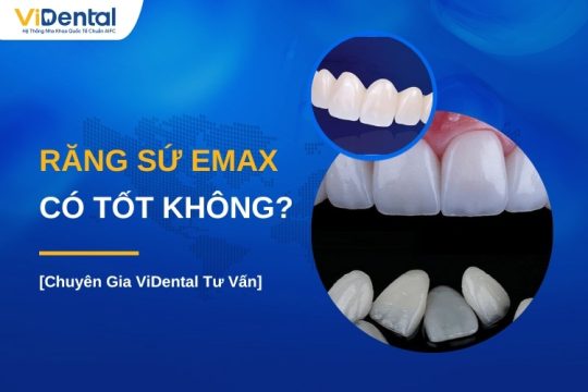 Răng sứ Emax có tốt không