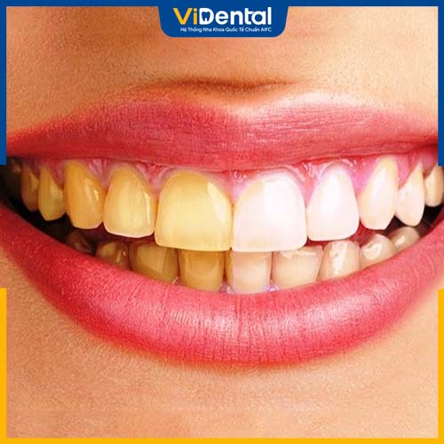 Bạn nên sử dụng răng sứ katana nếu răng thật đã bị ố màu
