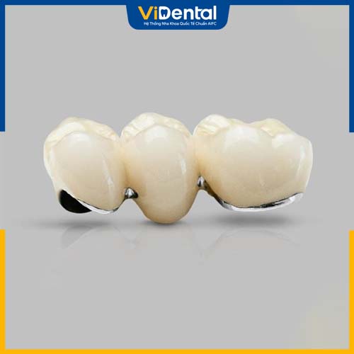 Răng sứ kim loại không tự nhiên  do có màu trắng đục