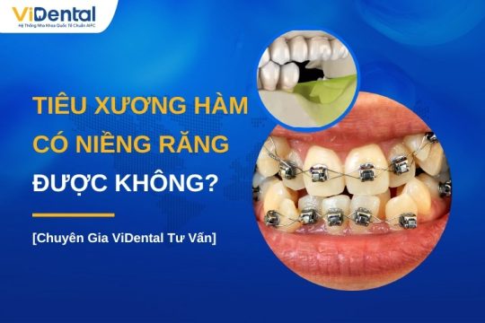 Tiêu xương hàm có niềng răng được không