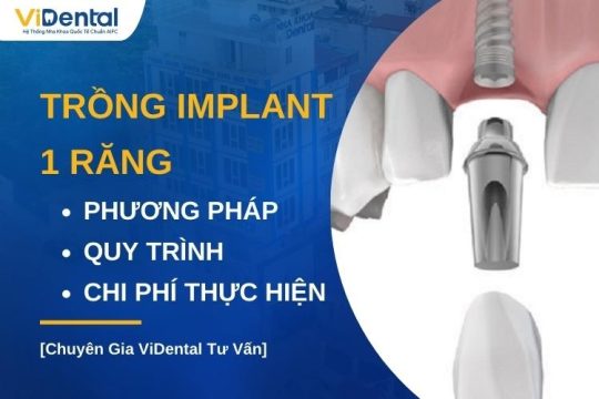 Trồng Răng Implant 1 Răng