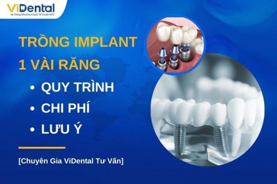 Trồng Răng Implant 1 Vài Răng