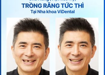 Khách hàng Nguyễn Quốc Hùng - Trông răng tức thì tại ViDental