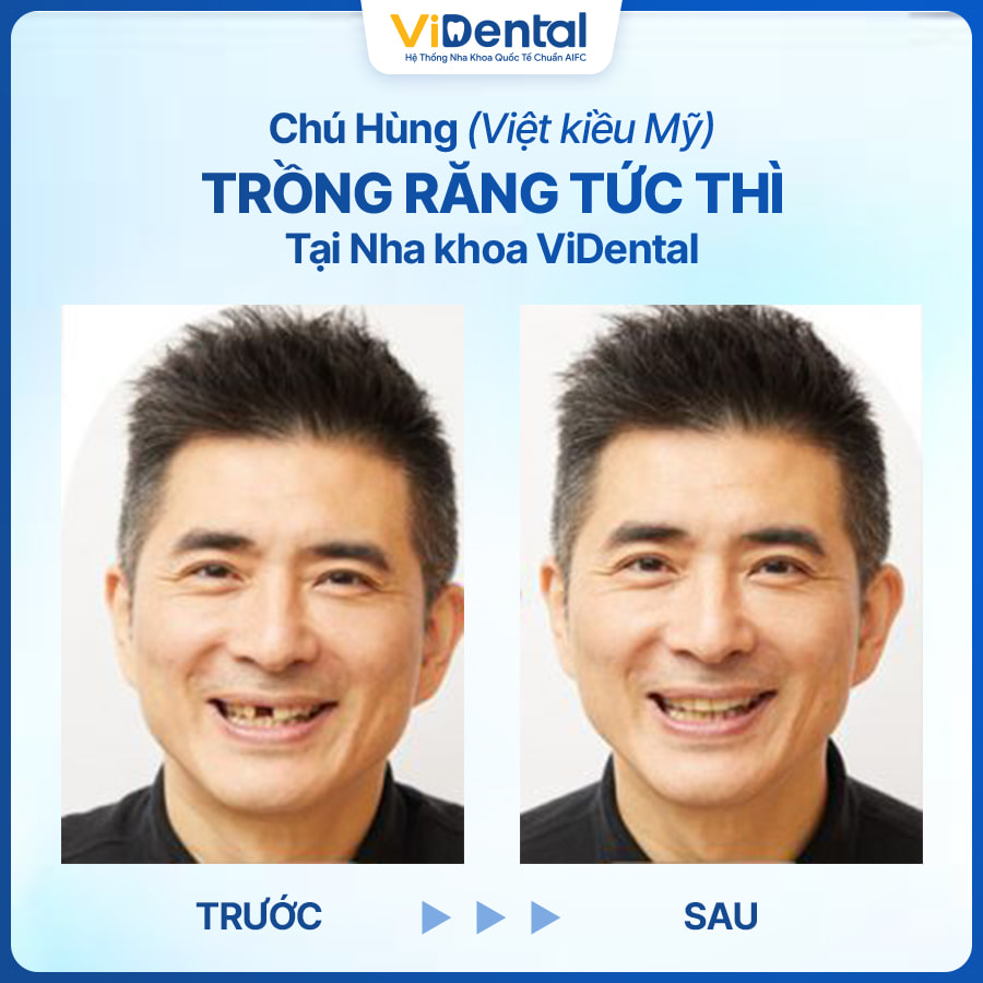 Chú Nguyễn Quốc Hùng - Trồng răng Implant tại Nha khoa ViDental