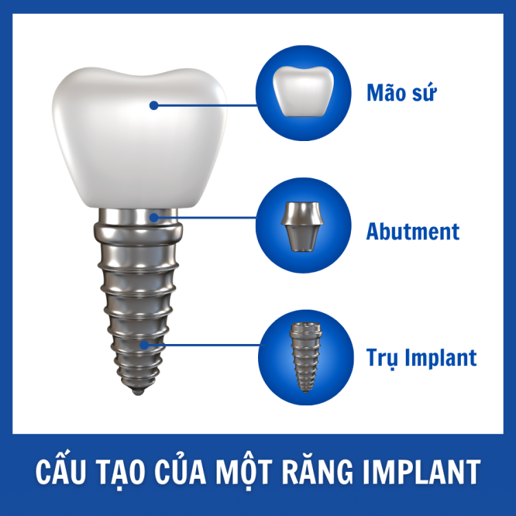 Trồng răng Implant toàn hàM (10)