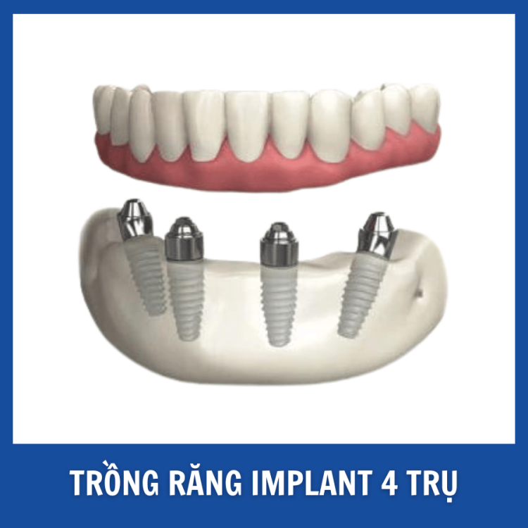 Trồng răng Implant toàn hàM (15)