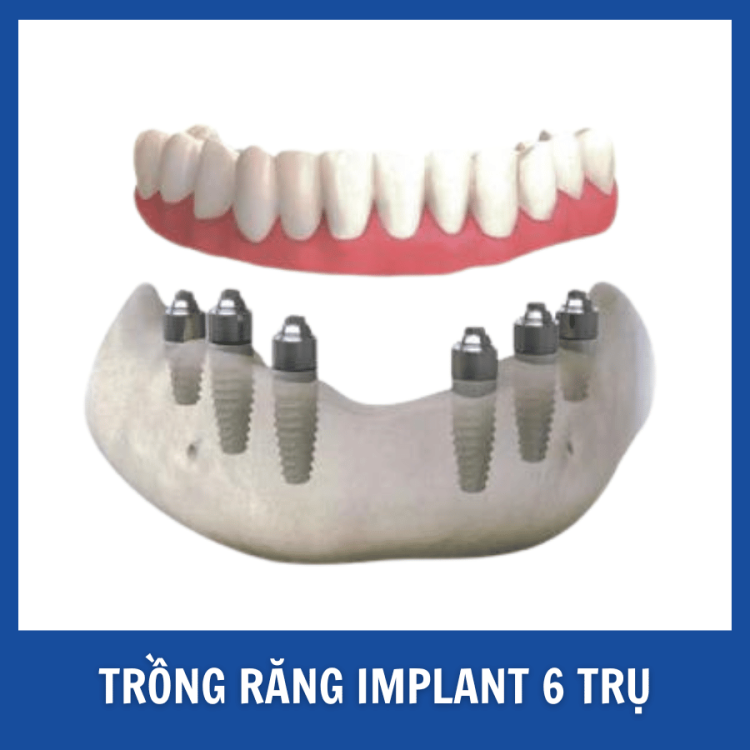 Trồng răng Implant toàn hàM (16)