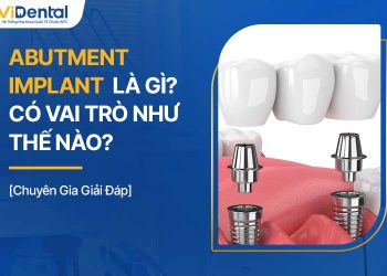 Abutment Implant Là Gì? Có Vai Trò Như Thế Nào?