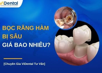 Bọc răng hàm bị sâu giá bao nhiêu