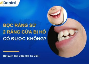 Bọc răng sứ 2 răng cửa bị hô có được không