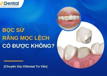 Bọc răng sứ cho răng mọc lệch