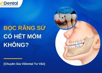 Bọc răng sứ có hết móm không