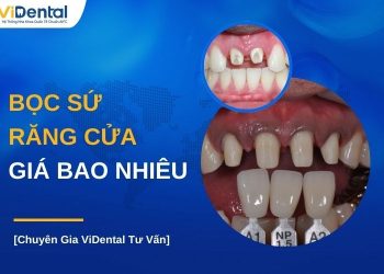 Bọc răng cửa giá bao nhiêu