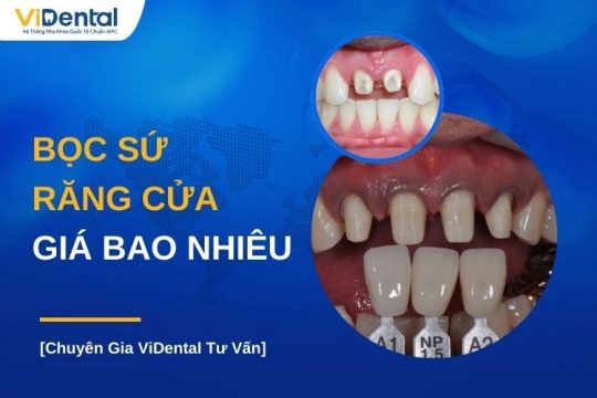 Bọc răng cửa giá bao nhiêu