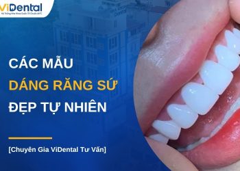 Các mẫu dáng răng sứ đẹp tự nhiên