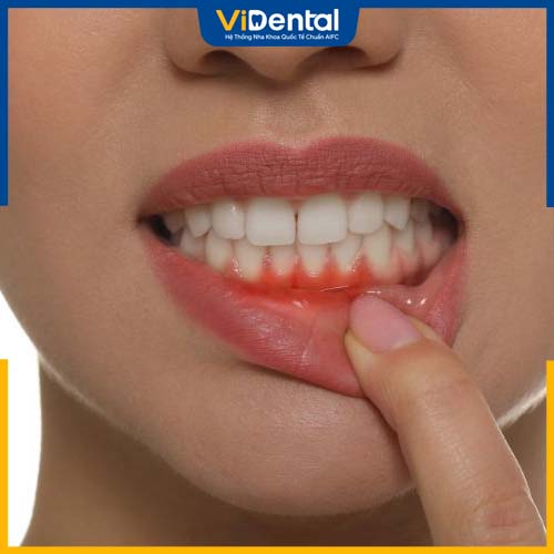 Nướu răng bị ngứa sau khi bọc
