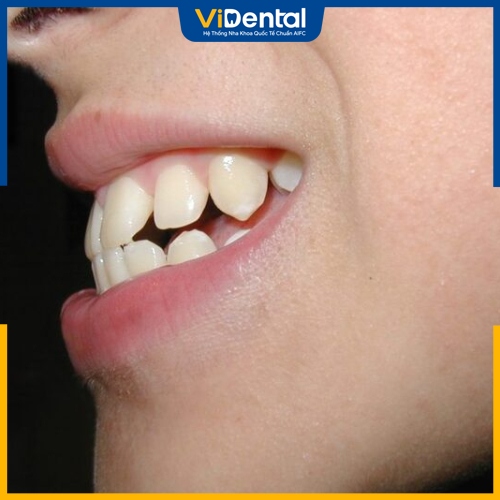 Mức độ hô hàm là yếu tố chính ảnh hưởng đến chi phí niềng răng