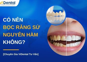 Có nên bọc răng sứ nguyên hàm không