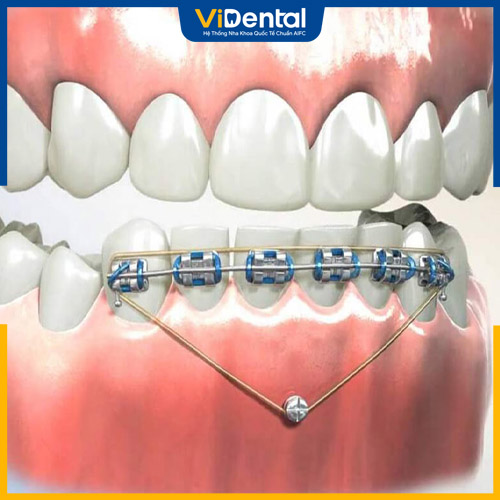 Đóng khoảng niềng răng là giai đoạn thứ 3 trong niềng răng