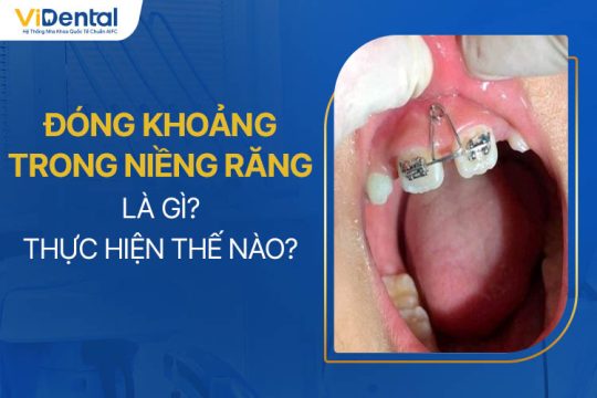 Đóng Khoảng Trong Niềng Răng Là Gì, Thực Hiện Thế Nào?