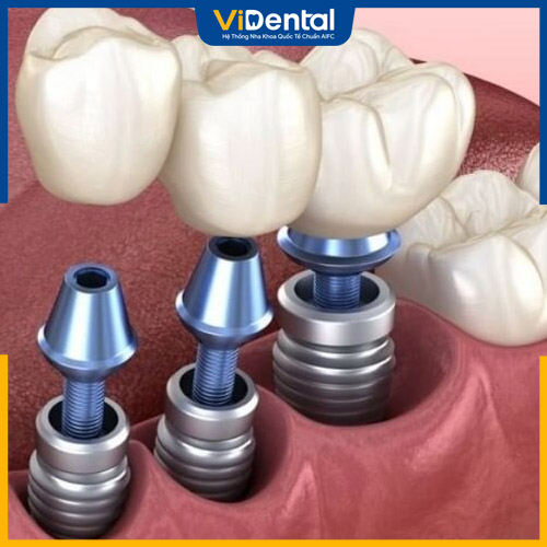 Implant Kontact cho hiệu quả phục hình răng khá tốt, tuổi thọ cao