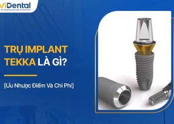 Trụ Implant Tekka Là Gì? Ưu Nhược Điểm Và Chi Phí