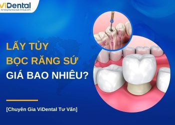 Lấy tủy bọc răng sứ giá bao nhiêu