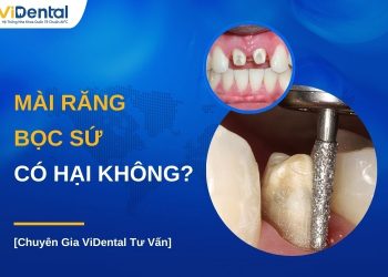 Mài răng bọc sứ có ảnh hưởng sức khỏe không