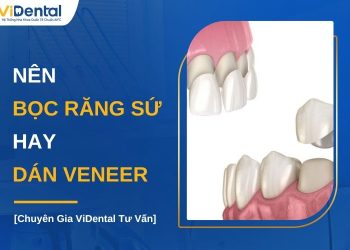 Nên bọc răng sứ hay dán veneer