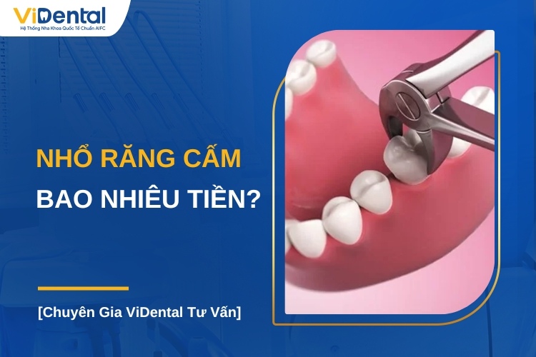 NHỔ RĂNG CẤM GIÁ BAO NHIÊU PHỤ THUỘC VÀO VỊ TRÍ VÀ ĐỘ PHỨC TẠP CỦA RĂNG