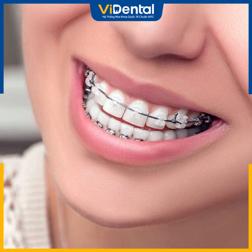 Niềng răng bằng mắc cài thường rút ngắn thời gian cho khách hàng