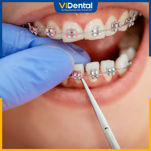 Quá trình nắn chỉnh răng khớp cắn ngược gồm 5 bước