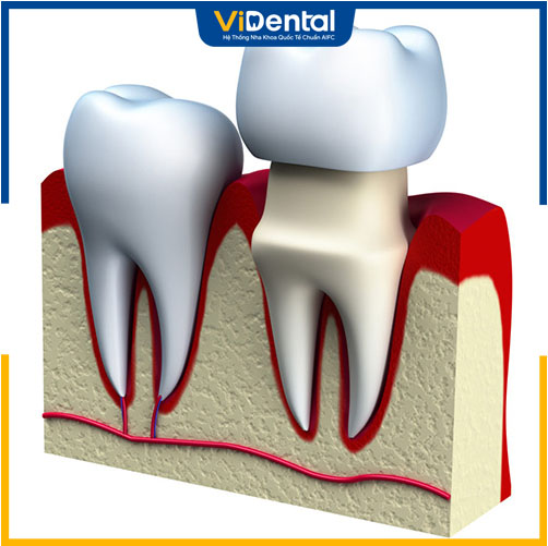 Chi phí bọc sứ sau khi lấy tủy phụ thuộc vào số lượng răng cần bọc