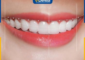Top 11 Dáng Răng Sứ Đẹp Nhất Hiện Nay Và Cách Chọn Răng Sứ Phù Hợp