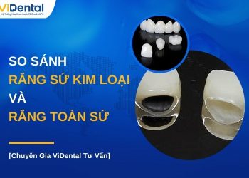 So sánh răng sứ kim loại và răng toàn sứ