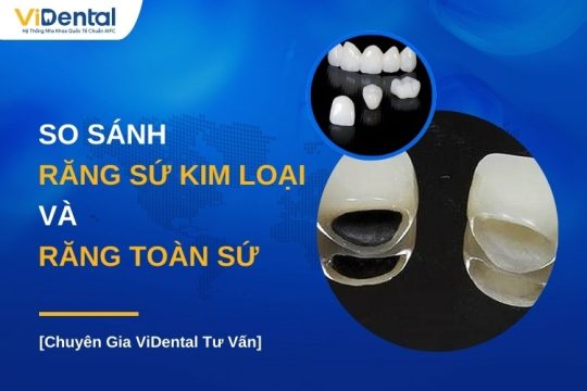 So sánh răng sứ kim loại và răng toàn sứ