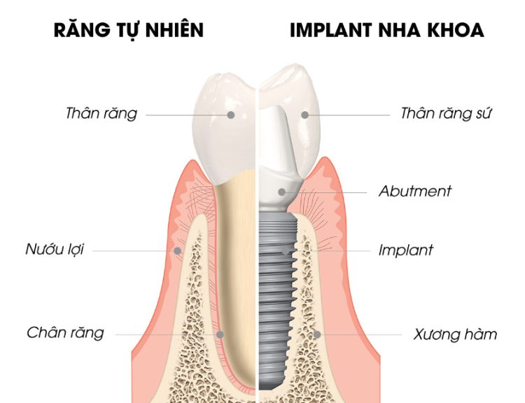su-khac-biet-trong-rang-implant-1-750x576.jpg