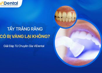 Tẩy Trắng Răng Có Bị Vàng Lại Không? Giải Đáp Từ Chuyên Gia Vidental