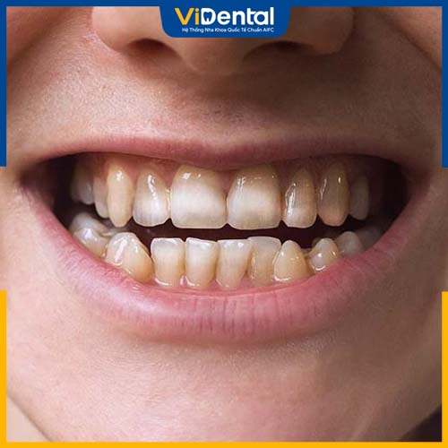 Nền răng yếu gây đau nhức khi tẩy trắng