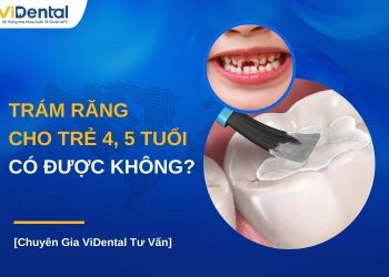 Trám răng cho trẻ 4, 5 tuổi có được không