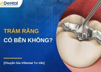 Trám răng có bền không