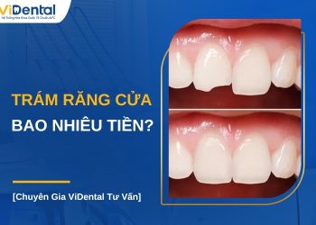 Trám răng cửa bao nhiêu tiền