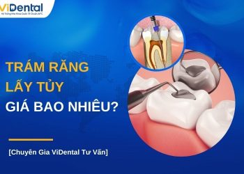 Trám răng lấy tủy giá bao nhiêu