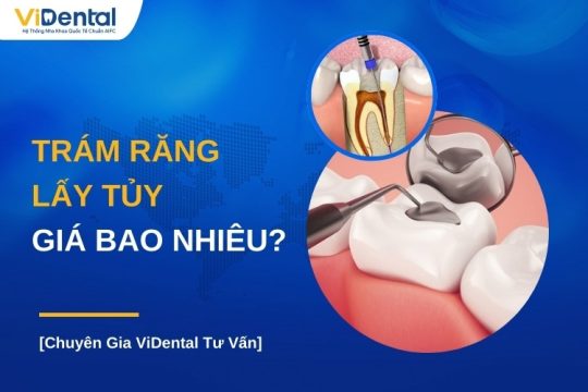 Trám răng lấy tủy giá bao nhiêu